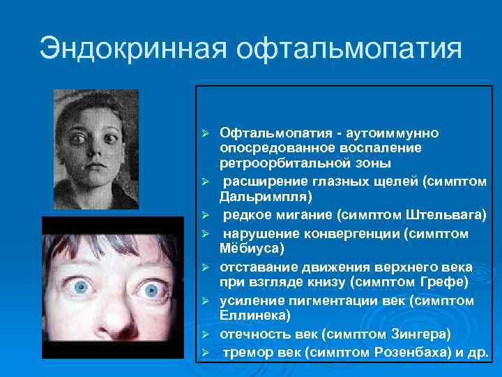 Признаки больных глаз. Эндокринологический экзофтальм. Офтальмопатия щитовидной железы. Тиреотоксикоз офтальмопатия.