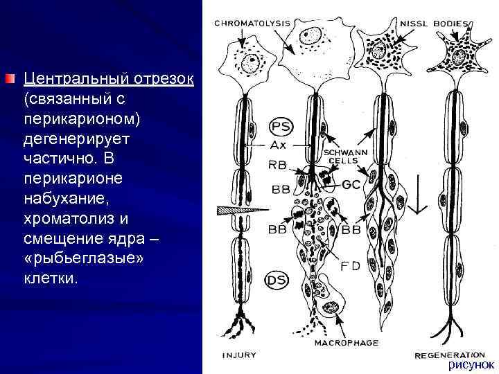 Центральный отрезок (связанный с перикарионом) дегенерирует частично. В перикарионе набухание, хроматолиз и смещение ядра