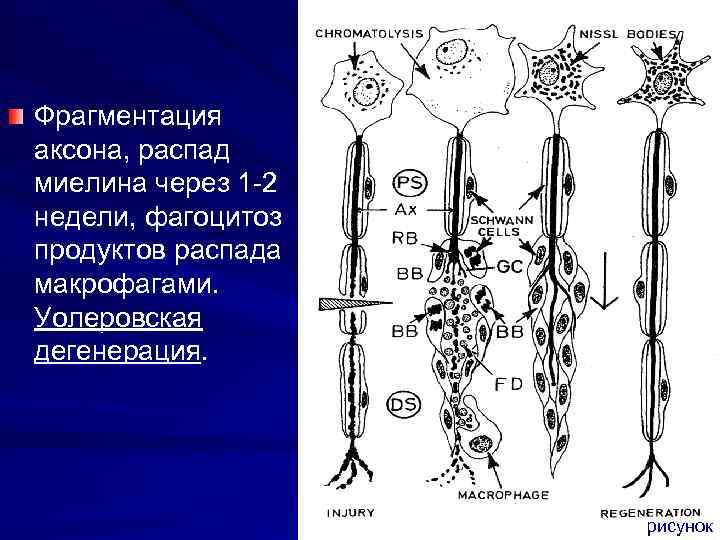 Фрагментация аксона, распад миелина через 1 -2 недели, фагоцитоз продуктов распада макрофагами. Уолеровская дегенерация.