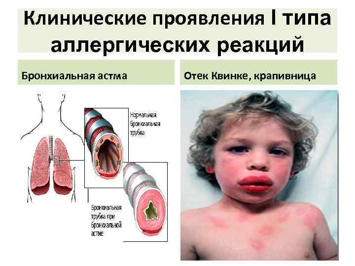 Клинические проявления Ι типа аллергических реакций Бронхиальная астма Отек Квинке, крапивница 