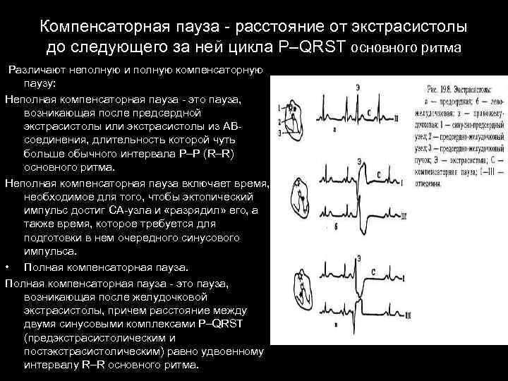 Компенсаторная пауза - расстояние от экстрасистолы до следующего за ней цикла P–QRST основного ритма