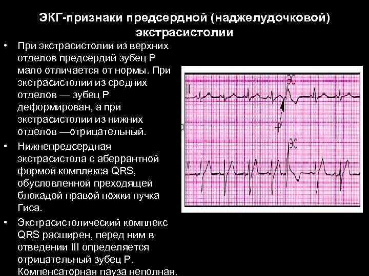 ЭКГ-признаки предсердной (наджелудочковой) экстрасистолии • При экстрасистолии из верхних отделов предсердий зубец Р мало