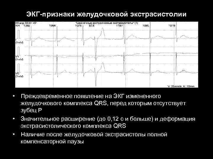 ЭКГ-признаки желудочковой экстрасистолии • Преждевременное появление на ЭКГ измененного желудочкового комплекса QRS, перед которым