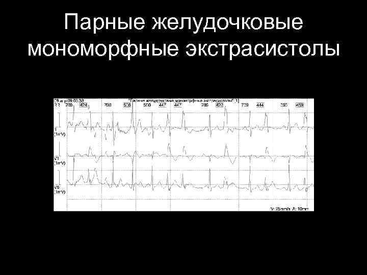 Парные желудочковые мономорфные экстрасистолы 