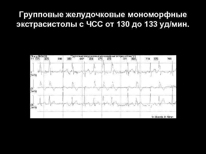 Групповые желудочковые мономорфные экстрасистолы с ЧСС от 130 до 133 уд/мин. 