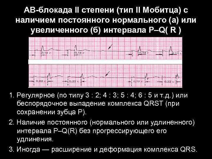 АВ-блокада II степени (тип II Мобитца) с наличием постоянного нормального (а) или увеличенного (б)