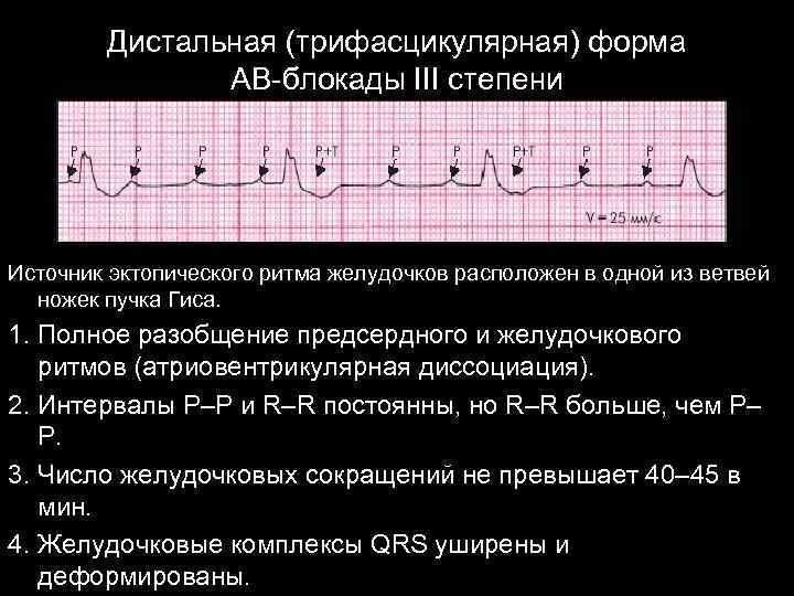Дистальная (трифасцикулярная) форма АВ-блокады III степени Источник эктопического ритма желудочков расположен в одной из