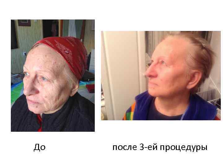 До после 3 -ей процедуры 