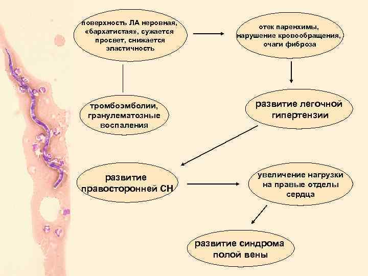 поверхность ЛА неровная, «бархатистая» , сужается просвет, снижается эластичность тромбоэмболии, гранулематозные воспаления развитие правосторонней