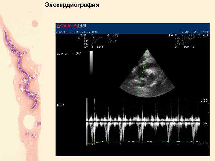 Эхокардиография 