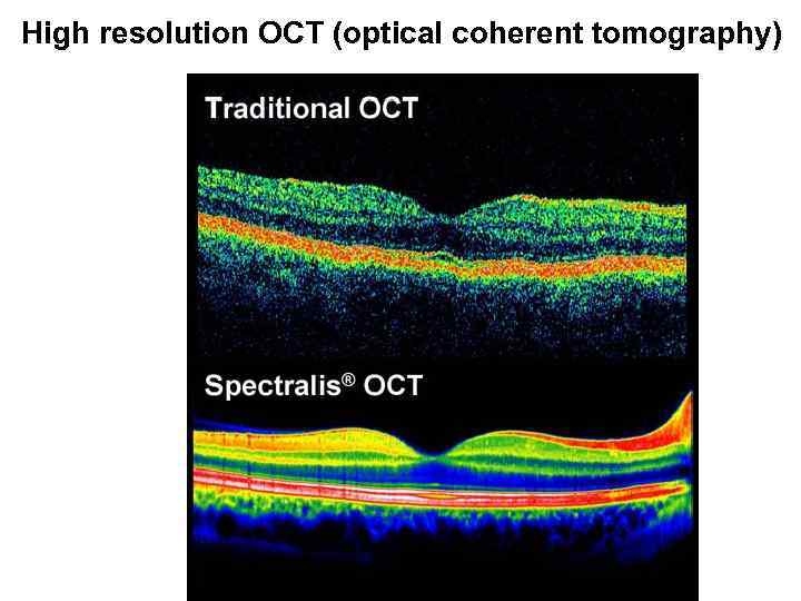 High resolution OCT (optical coherent tomography) 