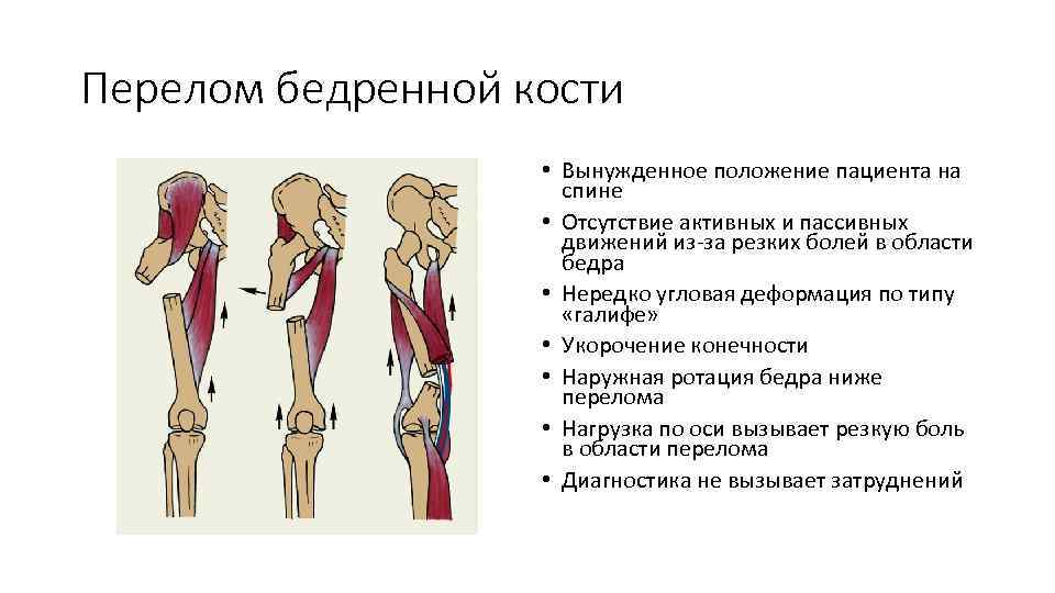 Перелом бедренной кости • Вынужденное положение пациента на спине • Отсутствие активных и пассивных