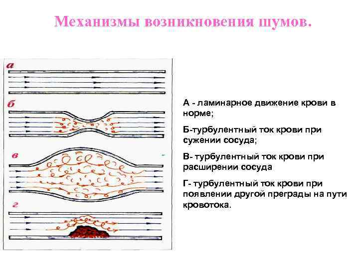 Ламинарный поток. Механизм возникновения шумов сердца. Ламинарный и турбулентный кровоток. Ламинарный и турбулентный ток крови. Типы кровотока ламинарный и турбулентный.