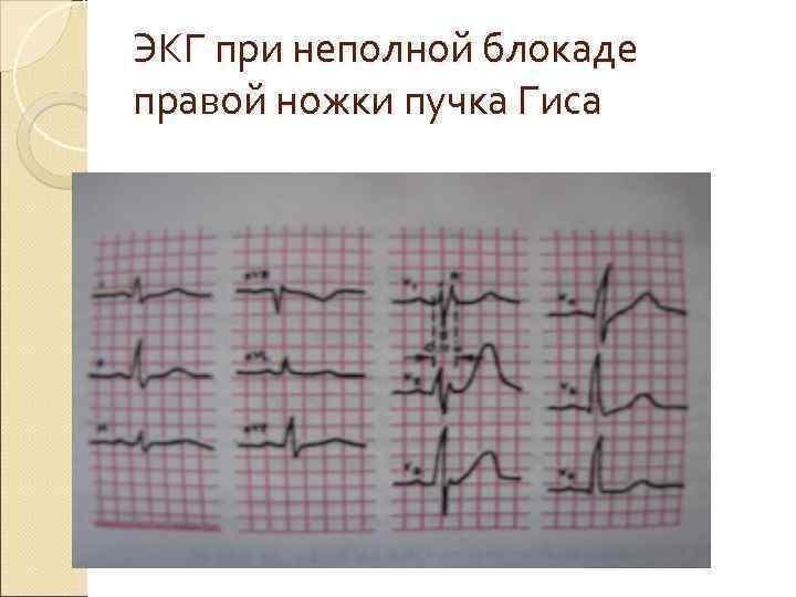 ЭКГ при неполной блокаде правой ножки пучка Гиса 