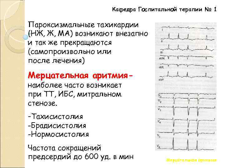 Кафедра Госпитальной терапии № 1 Пароксизмальные тахикардии (НЖ, Ж, МА) возникают внезапно и так