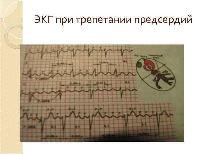 ЭКГ при трепетании предсердий 