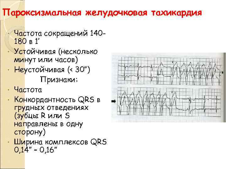 Пароксизмальная желудочковая тахикардия • • • Частота сокращений 140180 в 1’ Устойчивая (несколько минут
