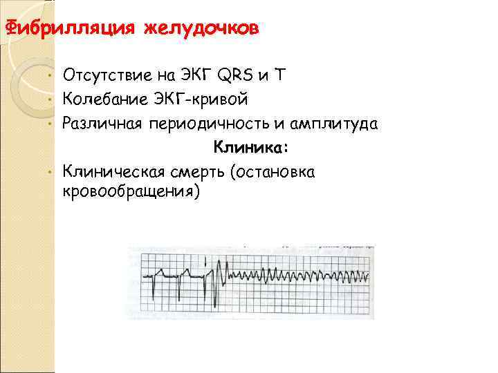 Фибрилляция желудочков Отсутствие на ЭКГ QRS и T • Колебание ЭКГ-кривой • Различная периодичность