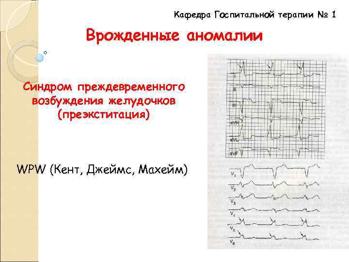 Кафедра Госпитальной терапии № 1 Врожденные аномалии Синдром преждевременного возбуждения желудочков (преэкститация) WPW (Кент,