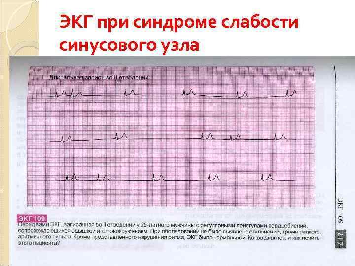 ЭКГ при синдроме слабости синусового узла 
