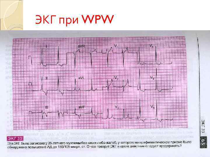 ЭКГ при WPW 