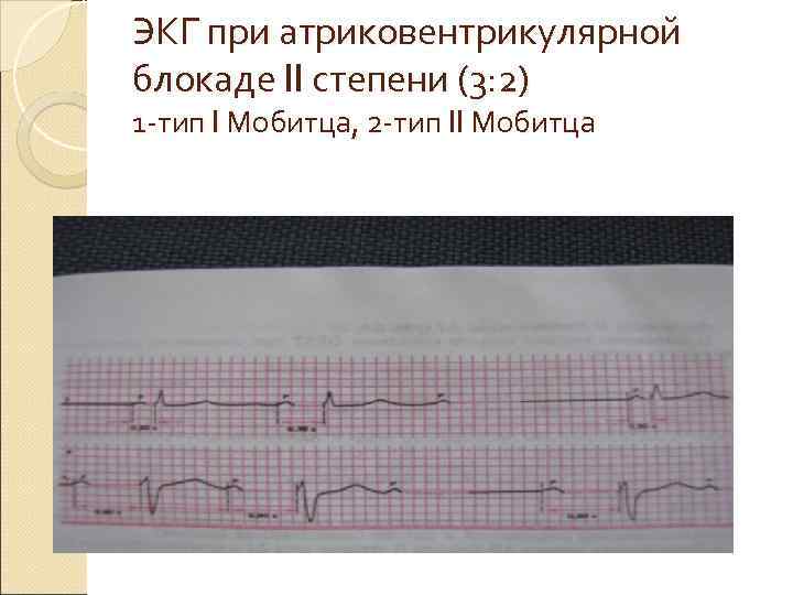 ЭКГ при атриковентрикулярной блокаде II степени (3: 2) 1 -тип I Мобитца, 2 -тип