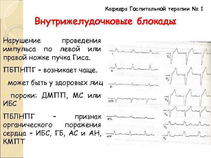 Кафедра Госпитальной терапии № 1 Внутрижелудочковые блокады Нарушение проведения импульса по левой или правой
