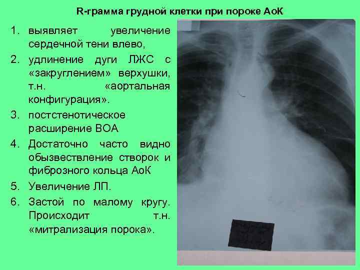 R-грамма грудной клетки при пороке Ао. К 1. выявляет увеличение сердечной тени влево, 2.