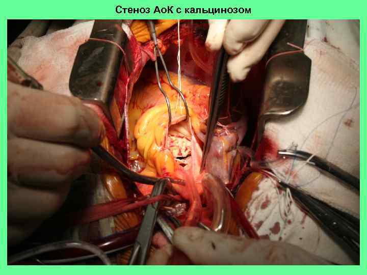 Стеноз Ао. К с кальцинозом 