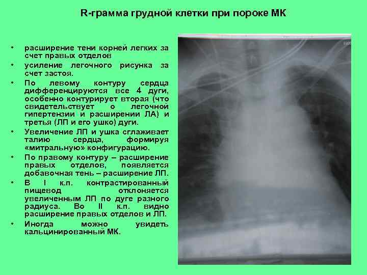R-грамма грудной клетки при пороке МК • • расширение тени корней легких за счет