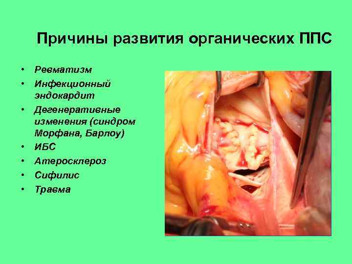Причины развития органических ППС • Ревматизм • Инфекционный эндокардит • Дегенеративные изменения (синдром Морфана,