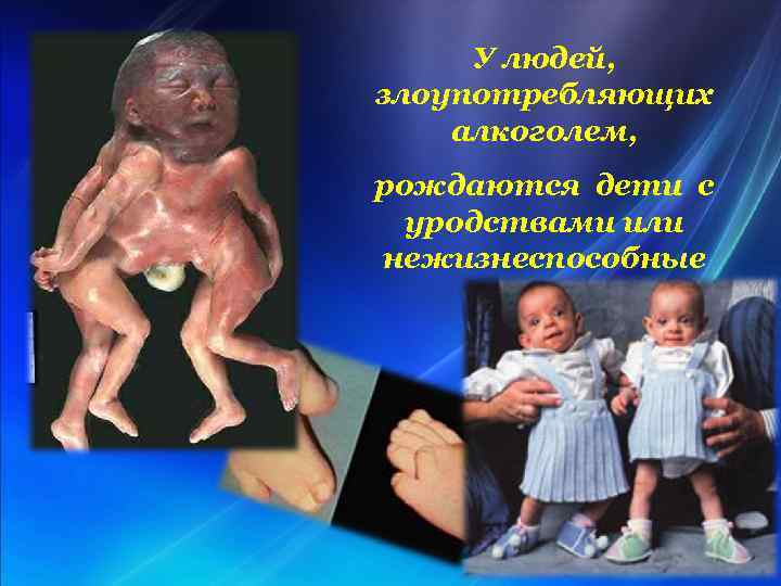 У людей, злоупотребляющих алкоголем, рождаются дети с уродствами или нежизнеспособные 