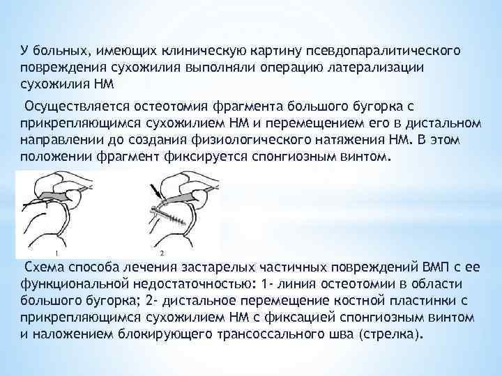 У больных, имеющих клиническую картину псевдопаралитического повреждения сухожилия выполняли операцию латерализации сухожилия НМ Осуществляется