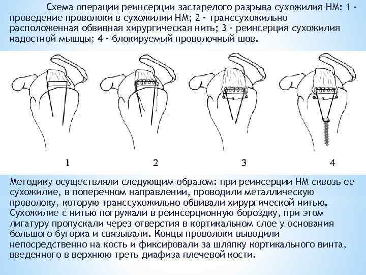 Схема операции реинсерции застарелого разрыва сухожилия НМ: 1 проведение проволоки в сухожилии НМ; 2