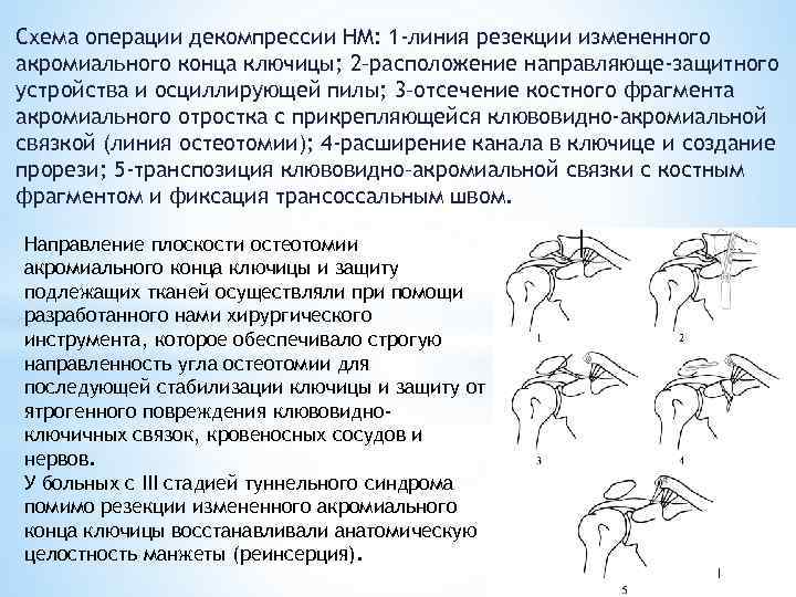 Схема операции декомпрессии НМ: 1 -линия резекции измененного акромиального конца ключицы; 2–расположение направляюще-защитного устройства