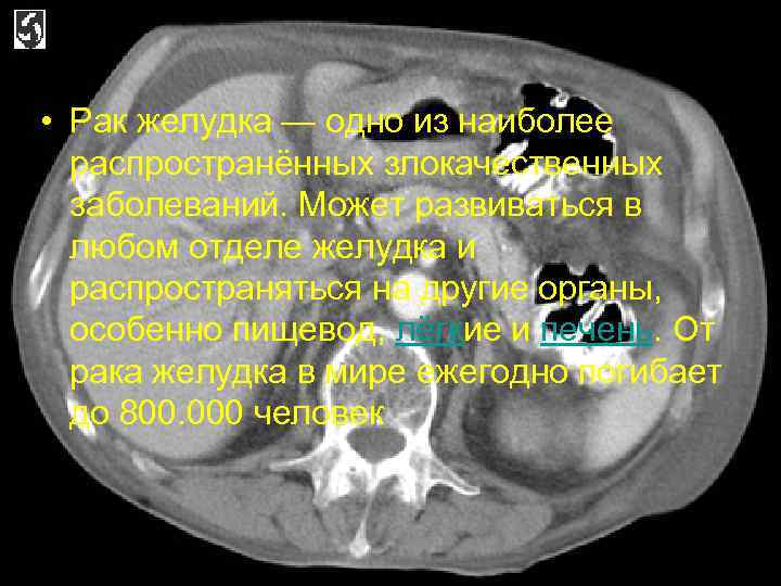  • Рак желудка — одно из наиболее распространённых злокачественных заболеваний. Может развиваться в