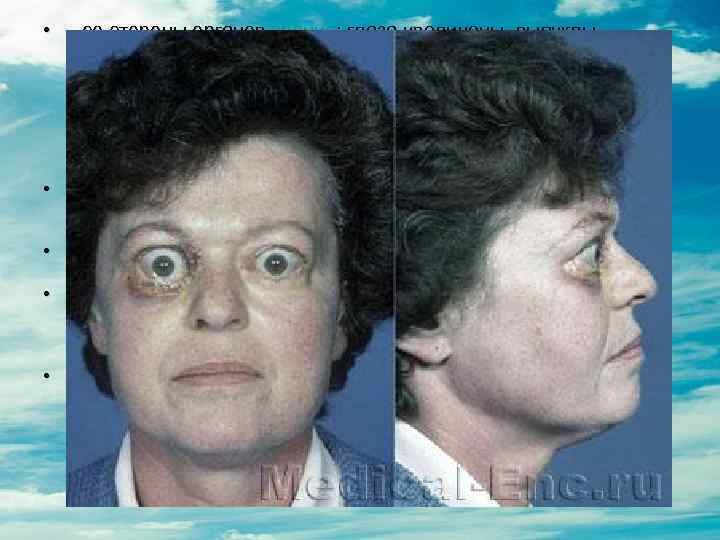  • - со стороны органов зрения: глаза увеличены, выпуклы, блестят, они широко раскрыты