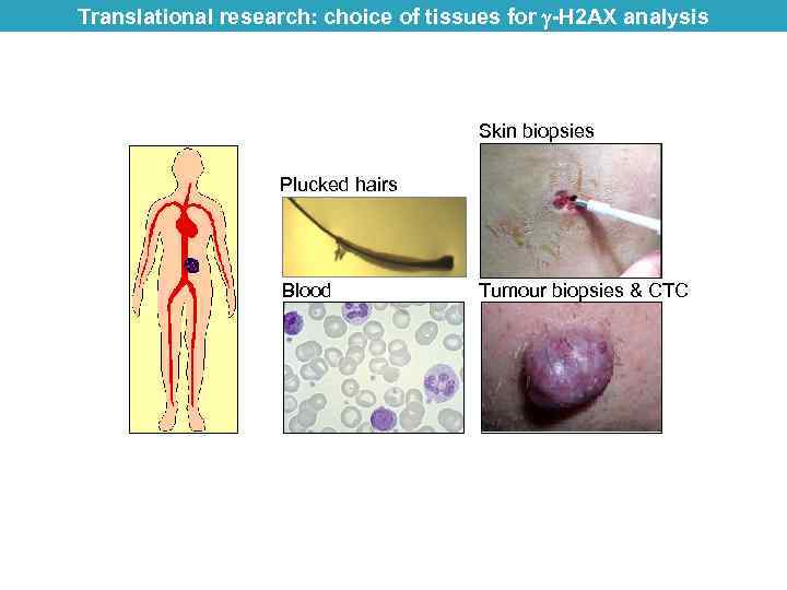 Translational research: choice of tissues for -H 2 AX analysis Skin biopsies Plucked hairs