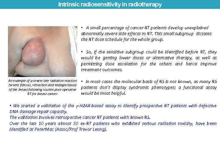 Intrinsic radiosensitivity in radiotherapy • A small percentage of cancer RT patients develop unexplained