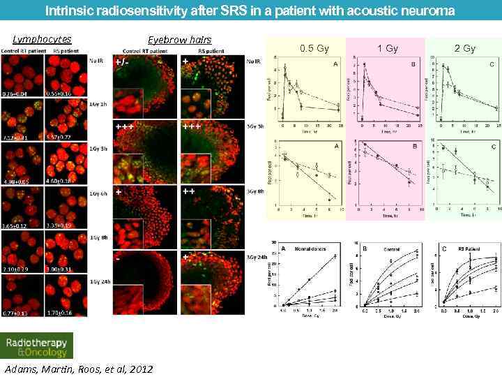 Intrinsic radiosensitivity after SRS in a patient with acoustic neuroma Lymphocytes Eyebrow hairs Adams,