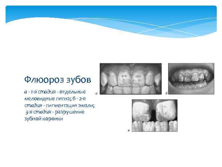 Флюороз зубов а - 1 -я стадия - отдельные меловидные пятна; б - 2