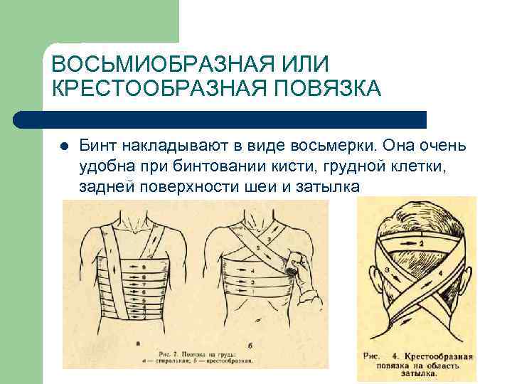 ВОСЬМИОБРАЗНАЯ ИЛИ КРЕСТООБРАЗНАЯ ПОВЯЗКА l Бинт накладывают в виде восьмерки. Она очень удобна при