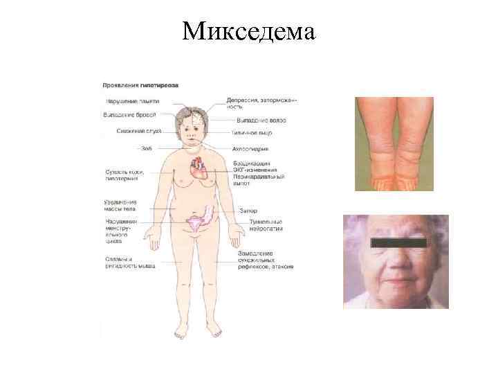 Микседема 