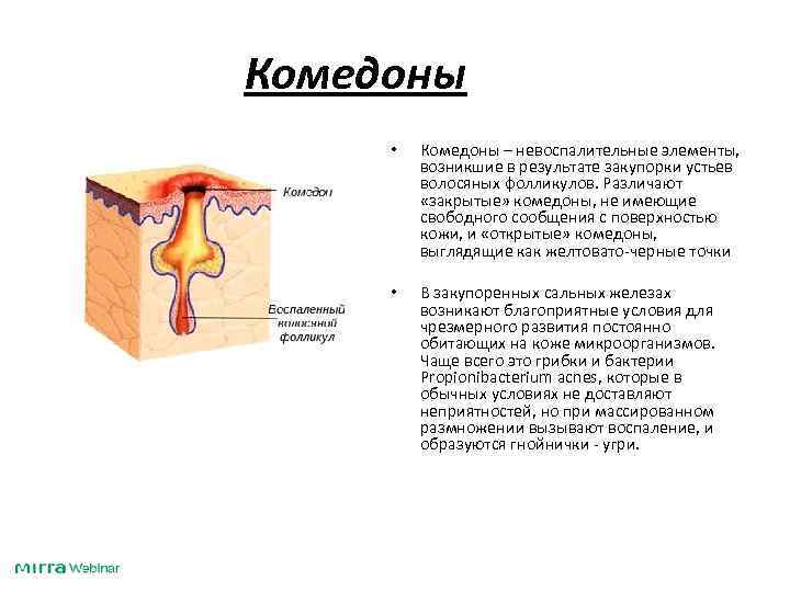 Комедоны • Комедоны – невоспалительные элементы, возникшие в результате закупорки устьев волосяных фолликулов. Различают