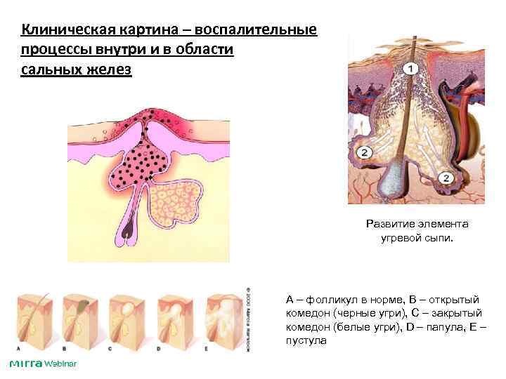 Клиническая картина – воспалительные процессы внутри и в области сальных желез Развитие элемента угревой