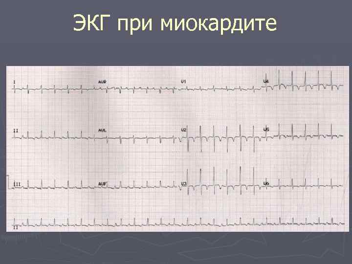 ЭКГ при миокардите 