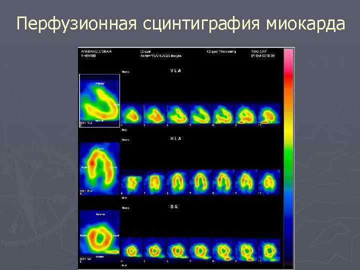 Перфузионная сцинтиграфия миокарда 