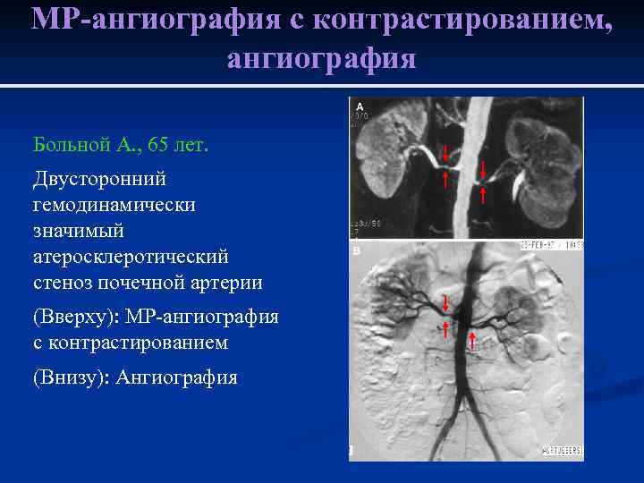 МР-ангиография с контрастированием, ангиография Больной А. , 65 лет. Двусторонний гемодинамически значимый атеросклеротический стеноз