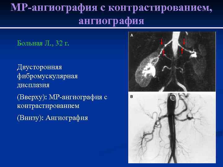 МР-ангиография с контрастированием, ангиография Больная Л. , 32 г. Двусторонняя фибромускулярная дисплазия (Вверху): МР-ангиография