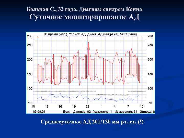 Больная С. , 32 года. Диагноз: синдром Конна Суточное мониторирование АД Среднесуточное АД 201/130